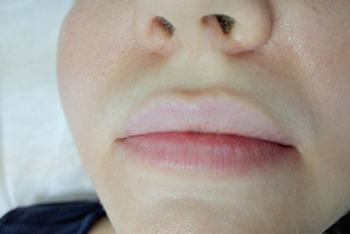 Дермальные филлеры Mesoestetic